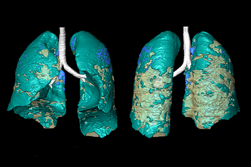 COVID ARDS Lung 3D model